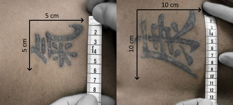 Grösse des Tattoos für die Tattooentfernung in St. Gallen ausmessen – Länge und Breite in Zentimetern