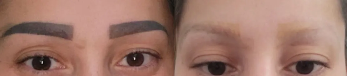 Microblading-Entfernung nach 4 Behandlungen in St. Gallen
