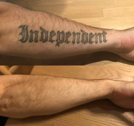 Tattooentfernung nach 6 Behandlungen mit dem PicoSure-Laser in St. Gallen